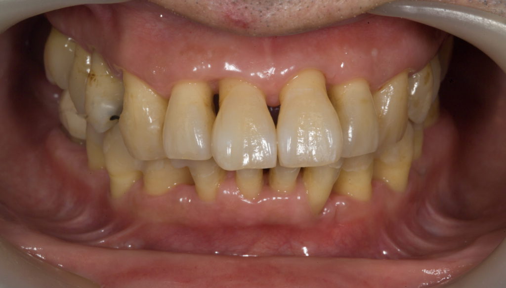 歯 周 病 で 歯 が グラグラ