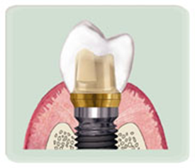 インプラントとは？