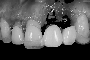 インプラント埋入手術