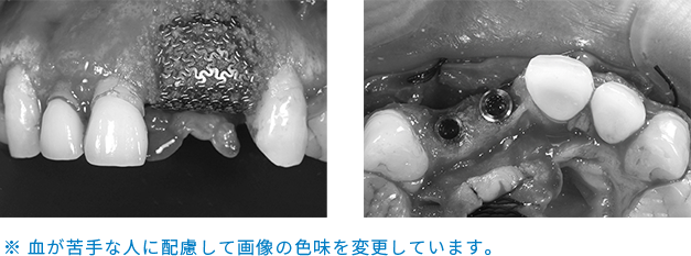 インプラント埋入手術