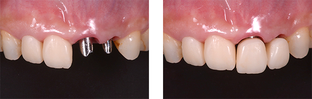 アバットメントの接続