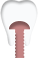 インプラント