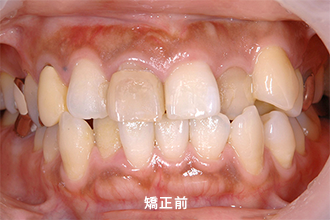 BEFORE(矯正前)