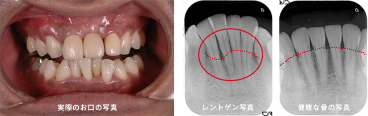 「下の前歯、歯肉が腫れた！」と来院された患者さま
