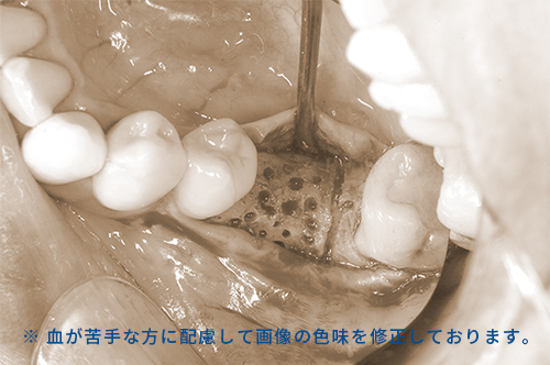 コルチトミー矯正