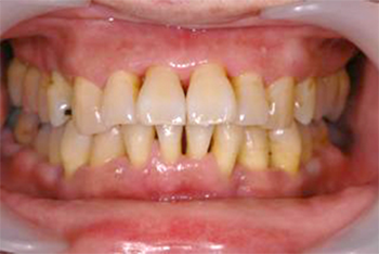 AFTER(歯周基本治療後)