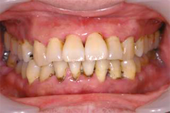 BEFORE(歯周基本治療前)