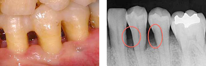 AFTER(歯周基本治療後　レントゲン)