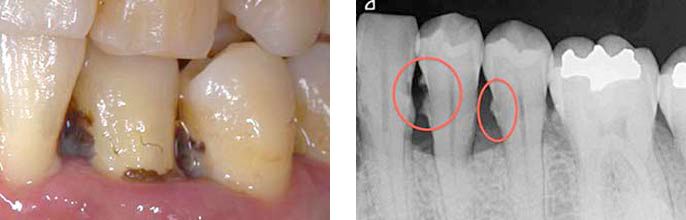 BEFORE(歯周基本治療前 レントゲン)