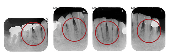 AFTER ( 術後：歯周組織再生療法 )