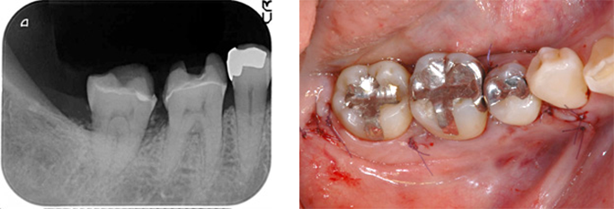 AFTER ( 術中・術後 )