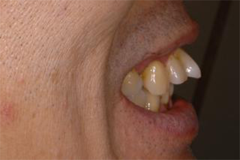 歯周ポケットを計測しているところ