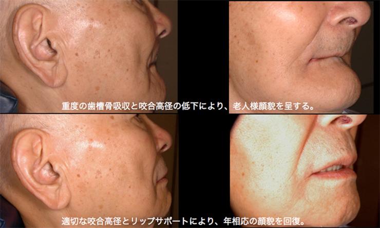 歯周病が進行すると？