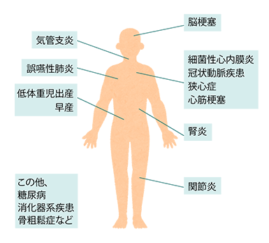 歯周病と全身疾患歯周病は細菌による感染症ですが、生活習慣病でもあります。