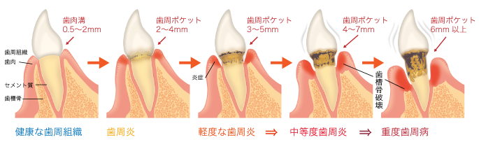 歯周病をステージごとに治療の流れをご説明します。