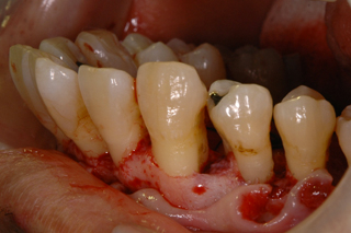 オープンフラップデブライドメント