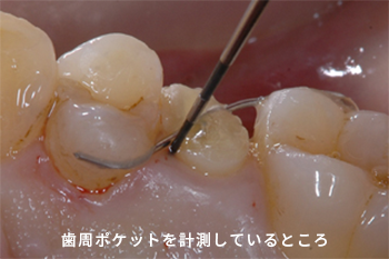 歯周ポケットを計測しているところ