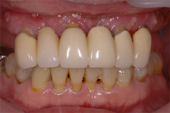 歯の周囲に歯石がつき、歯肉が腫れている状態