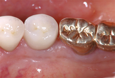 自家歯牙移植のメリット