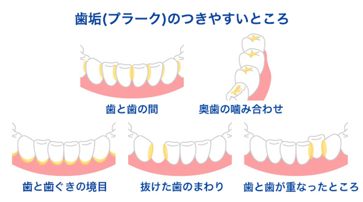 歯垢（プラーク）と歯石の違いは何？