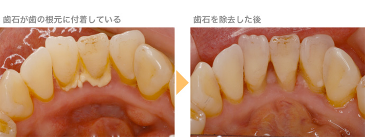 歯石はどこに付着するの？