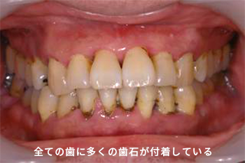 歯周病治療 健造デンタルクリニック
