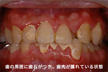 歯 見える から 歯茎 が 歯の根っこが歯茎から出てくることってあるんでしょうか？歯茎から、