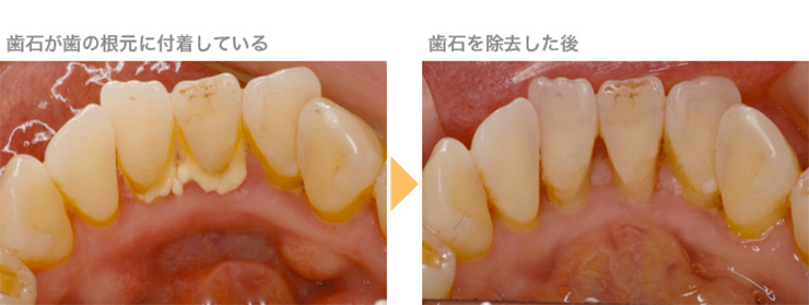 予防歯科 | 健造デンタルクリニック