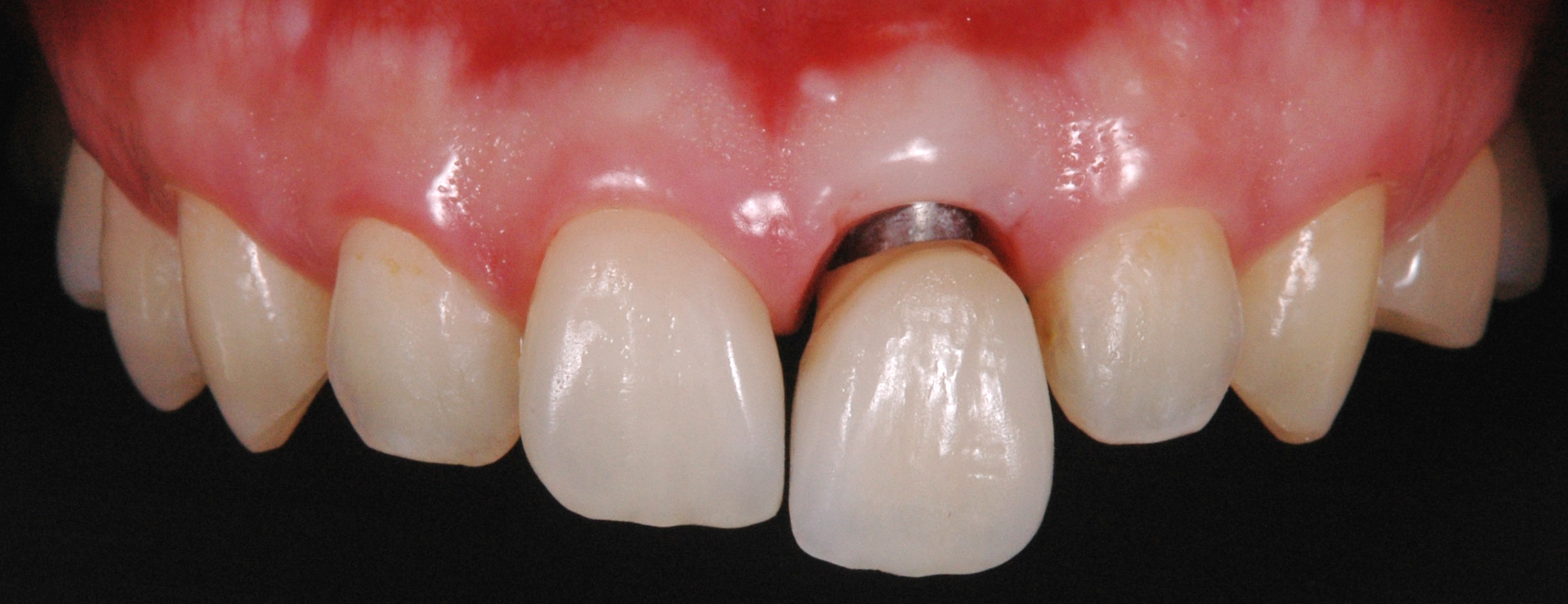 前歯１本インプラント治療後