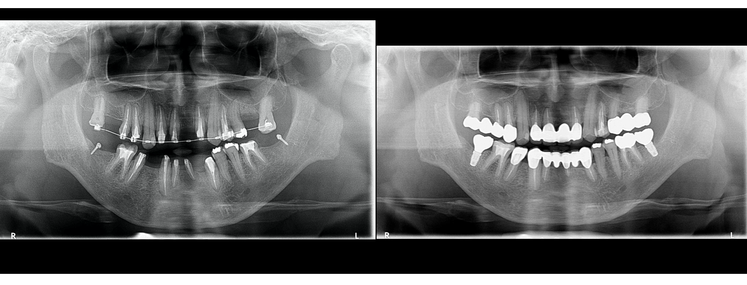 治療期間５年半、当院チーム治療によってまたお一人安定した噛み合わせを回復されました！！