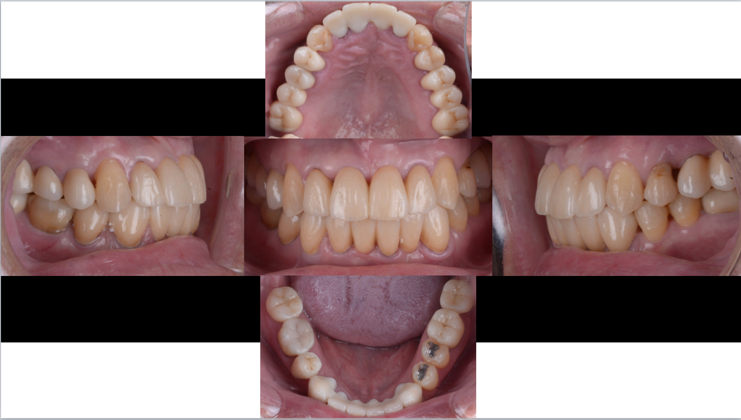 治療期間５年半、当院チーム治療によってまたお一人安定した噛み合わせを回復されました！！