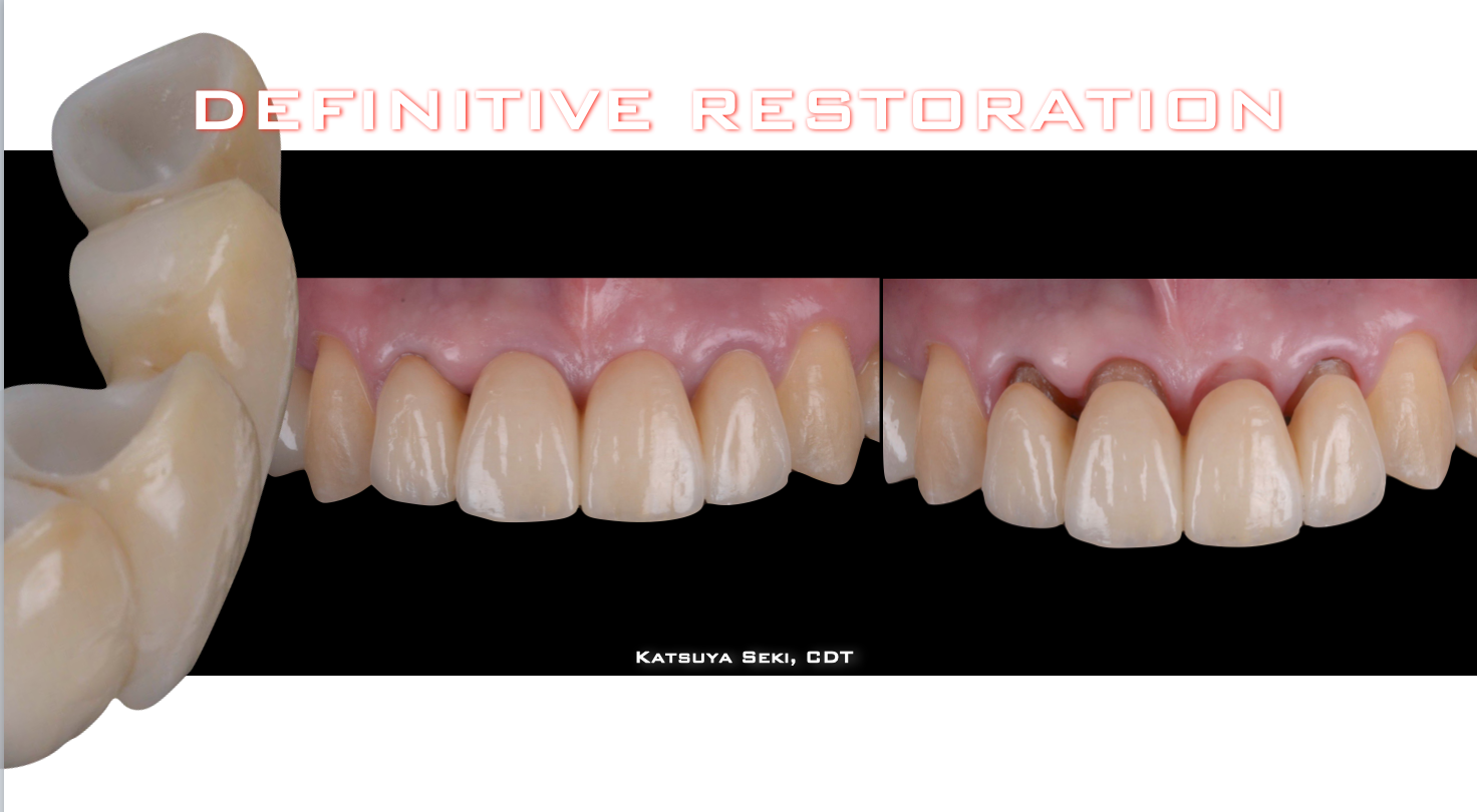治療期間５年半、当院チーム治療によってまたお一人安定した噛み合わせを回復されました！！