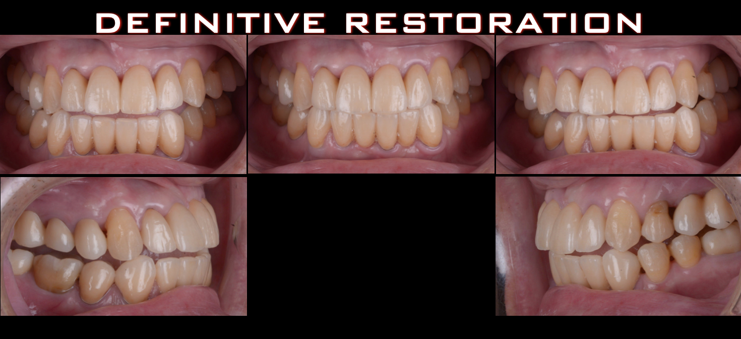 治療期間５年半、当院チーム治療によってまたお一人安定した噛み合わせを回復されました！！