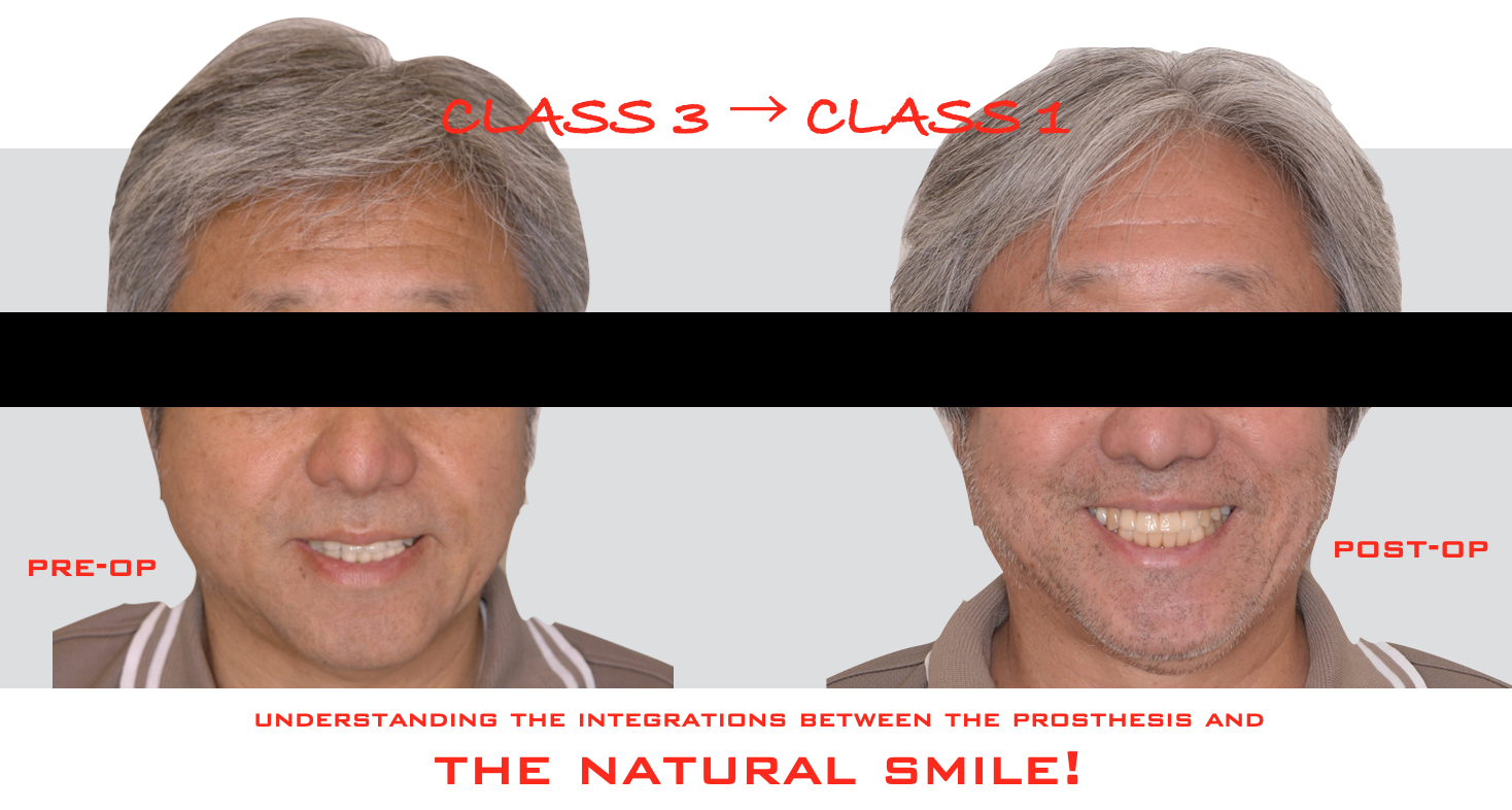 治療期間５年半、当院チーム治療によってまたお一人安定した噛み合わせを回復されました！！