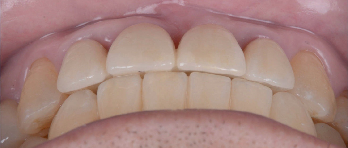 治療期間５年半、当院チーム治療によってまたお一人安定した噛み合わせを回復されました！！