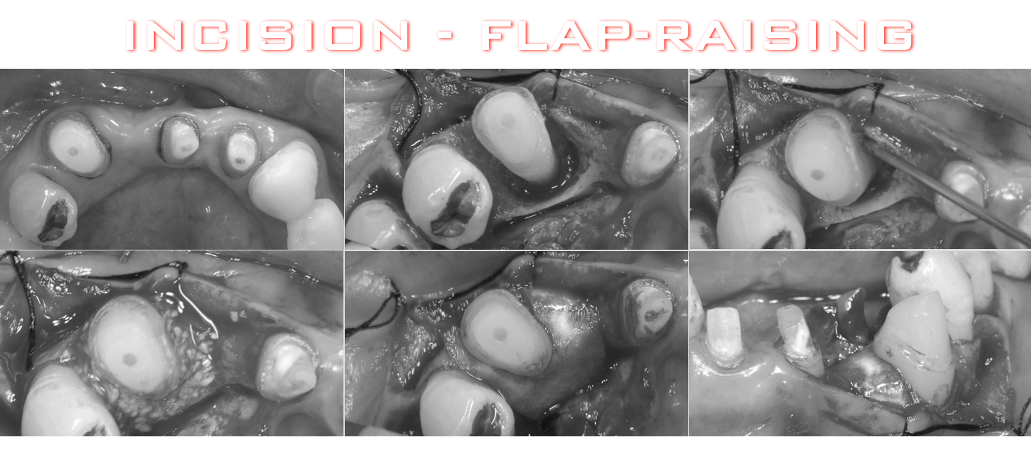 治療期間５年半、当院チーム治療によってまたお一人安定した噛み合わせを回復されました！！
