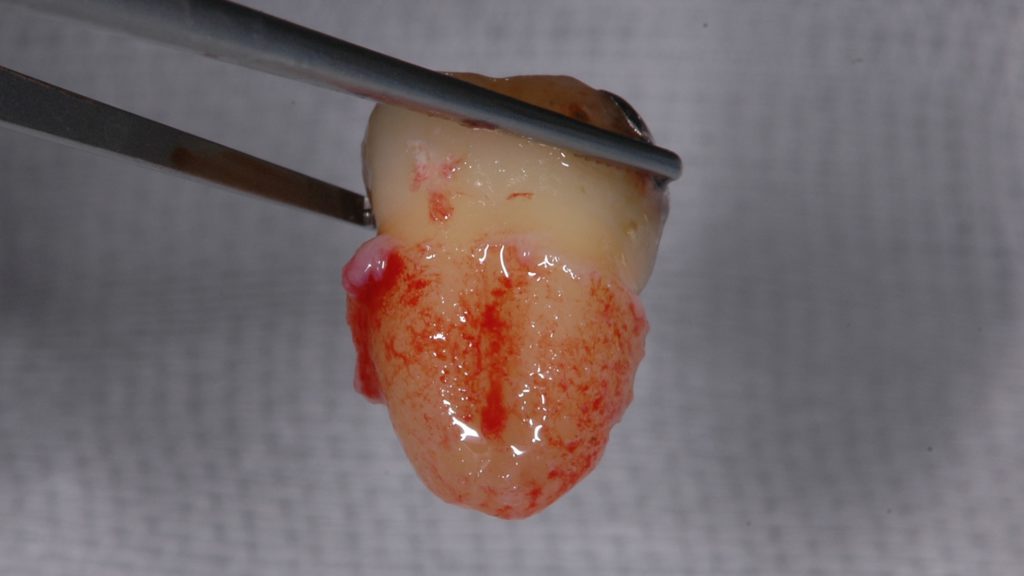 歯根膜がほぼ完璧に残っている親知らず