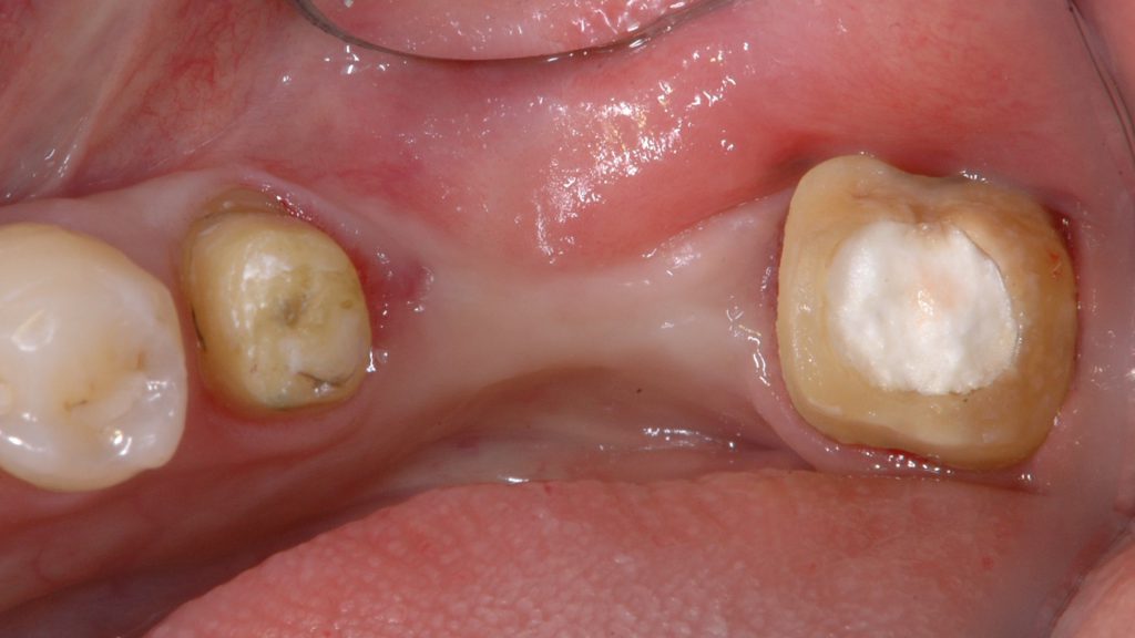 角化歯肉手術