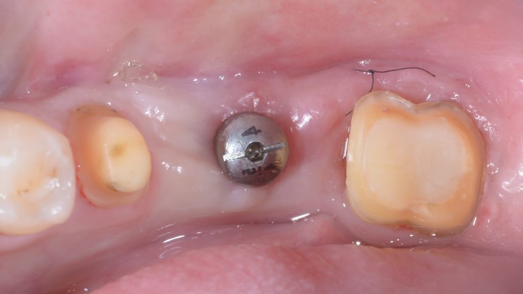 角化歯肉手術
