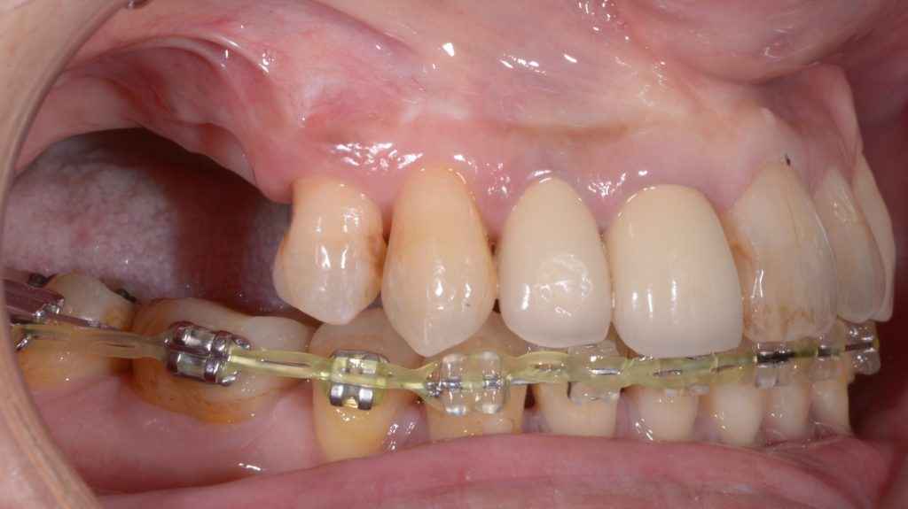 奥歯のインプラント術期間