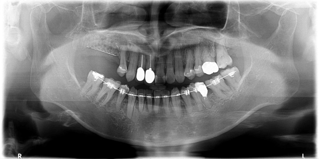 奥歯のインプラント再生治療レントゲン