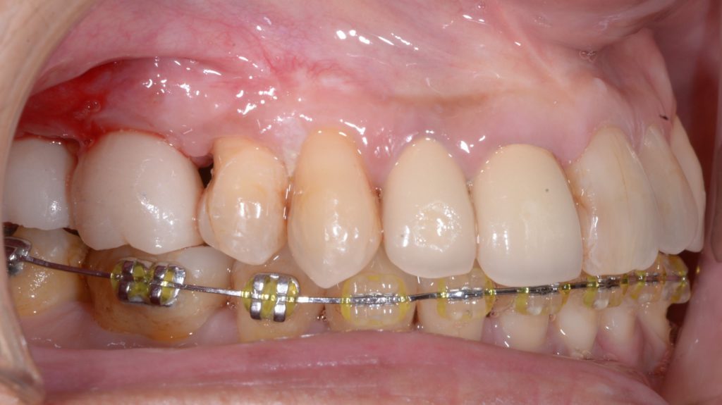 奥歯のインプラント