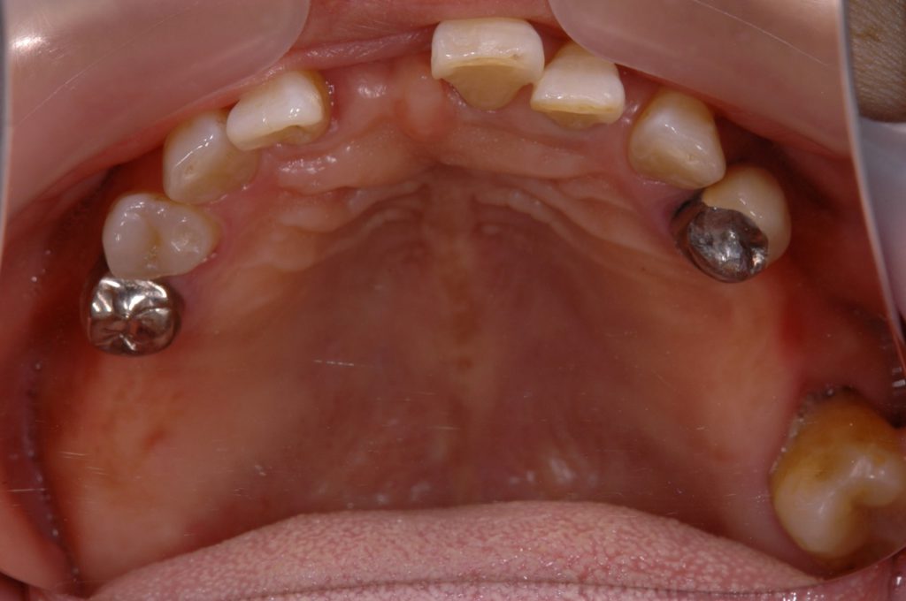 奥歯のインプラント術中