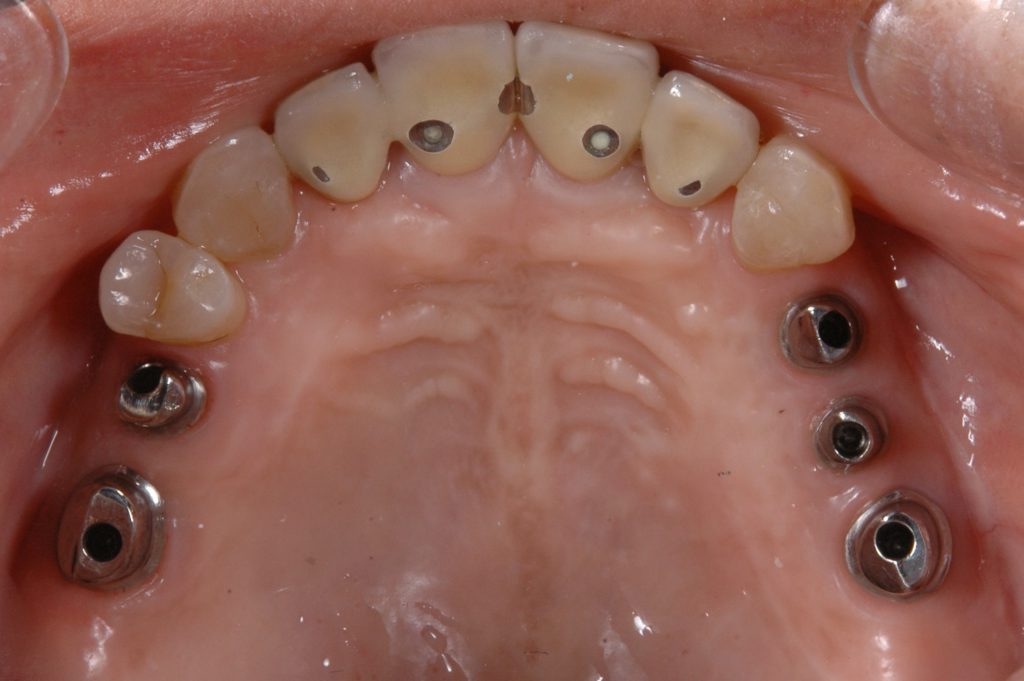 奥歯のインプラント術中