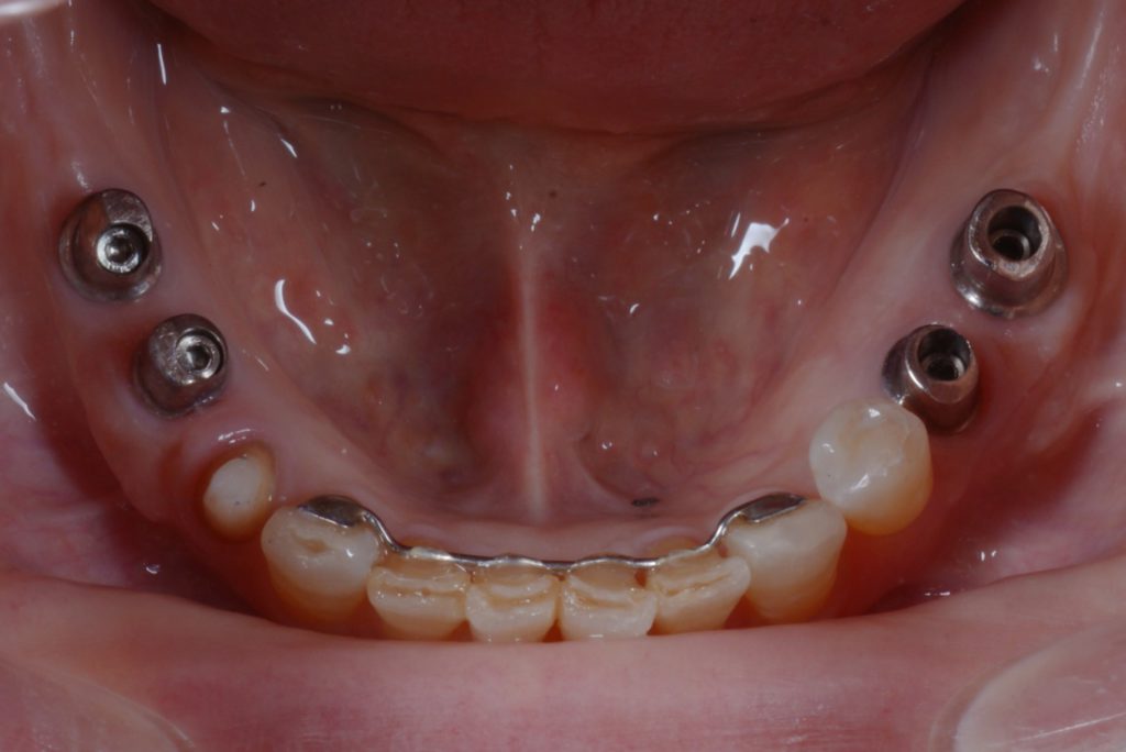 奥歯のインプラント審美治療