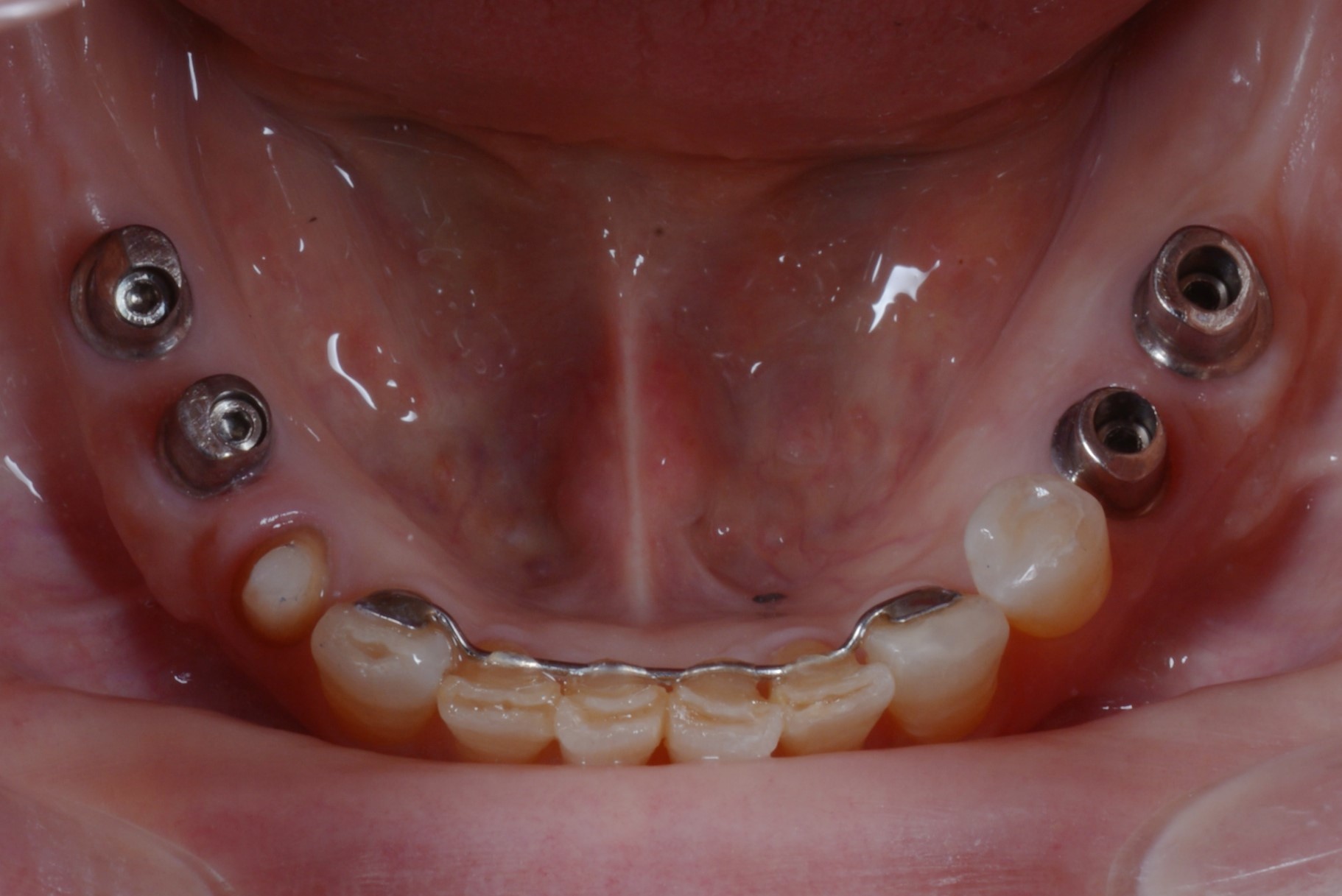 奥歯のインプラント