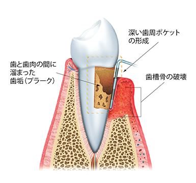 歯周病治療 | 学芸大学の歯医者・歯科 | 健造デンタルクリニック