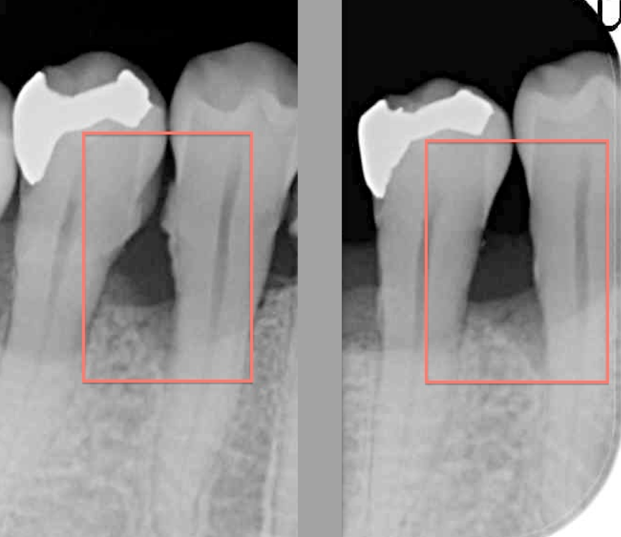 歯周病レントゲン