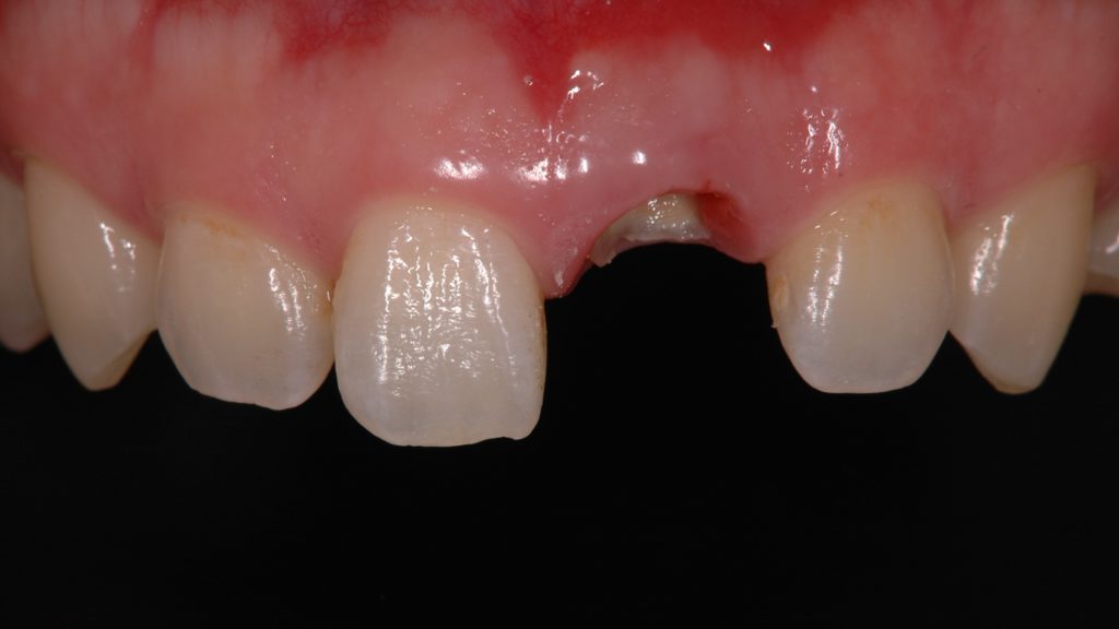 前歯が折れた 前歯の治療 どこでどんな治療しますか 健造デンタルクリニック