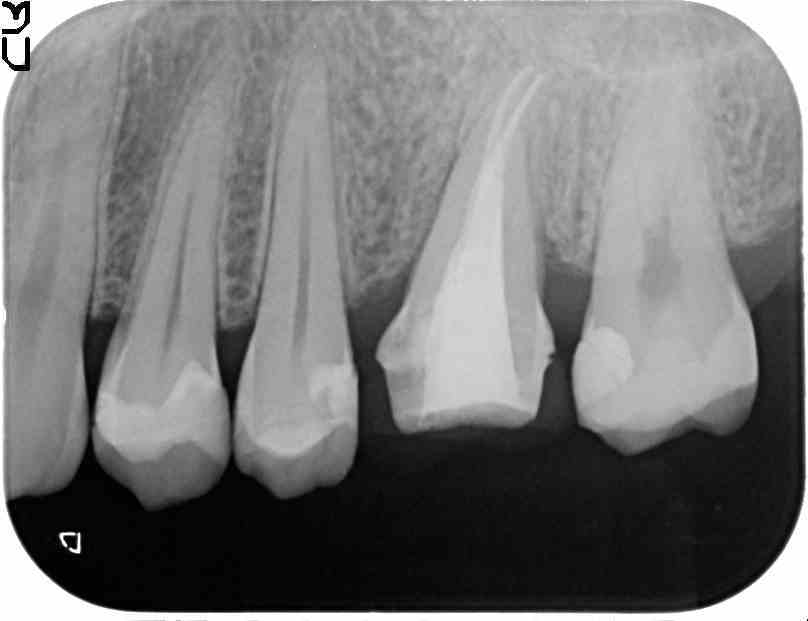 仮歯を入れる際のレントゲン